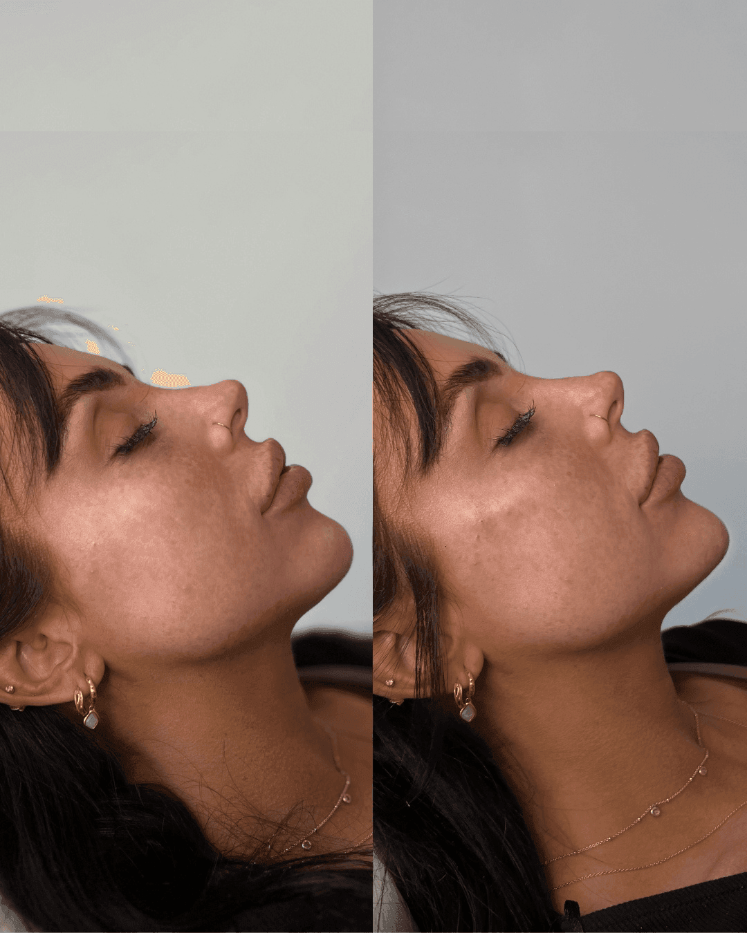 Cheek Filler