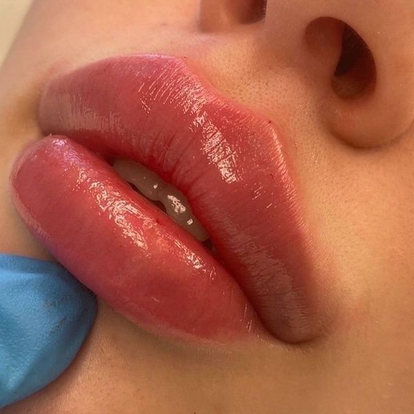 Lip Filler 1ml