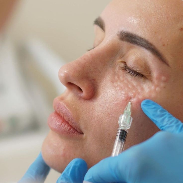Skin Boosters